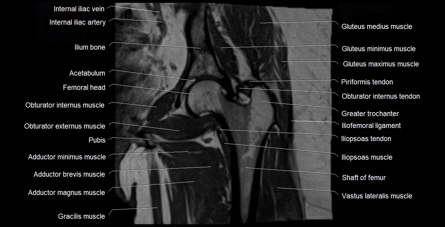 MRI Hip 3T coronal cross sectional anatomy image 35.webp